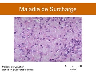 Maladie de Surcharge Maladie de Gaucher Déficit en glucocérebrosidase A B enzyme 