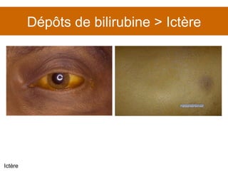 Dépôts de bilirubine > Ictère Ictère 