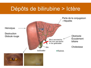 Dépôts de bilirubine > Ictère Perte de la conjugaison - Hépatite Hémolyse Destruction Globule rouge Obstracle Écoulement biliaire Cholestase 