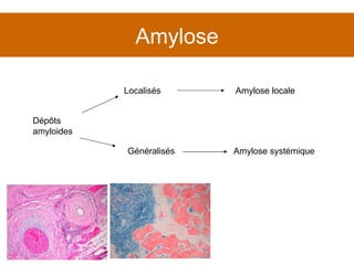 Amylose Dépôts  amyloides Localisés Généralisés Amylose locale Amylose systémique 