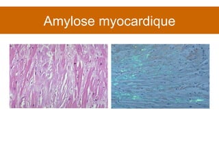 Amylose myocardique 