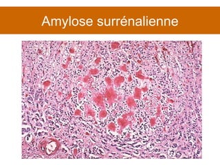 Amylose surrénalienne 