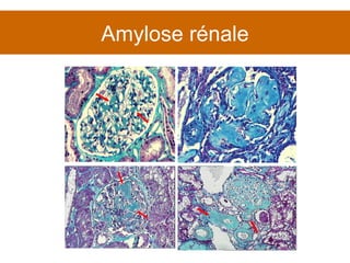 Amylose rénale 