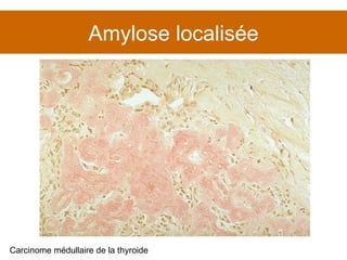 Amylose localisée Carcinome médullaire de la thyroide 