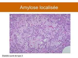 Amylose localisée Diabète sucré de type 2 