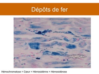 Dépôts de fer Hémochromatose > Cœur > Hémosidérine > Hémosidérose 