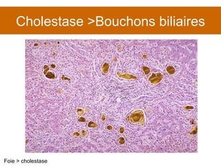 Cholestase >Bouchons biliaires Foie > cholestase 