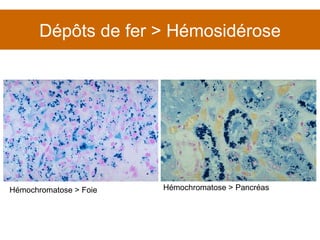 Dépôts de fer > Hémosidérose Hémochromatose > Foie Hémochromatose > Pancréas 