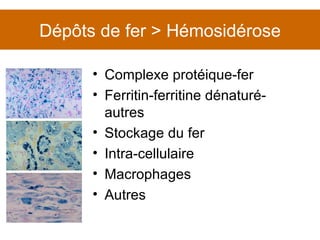 Dépôts de fer > Hémosidérose Complexe protéique-fer Ferritin-ferritine dénaturé-autres Stockage du fer Intra-cellulaire Macrophages Autres 