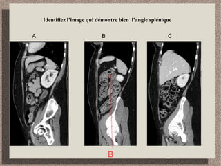 En vous référant au pancréas, identifiez la portion visible de l’estomac.
 