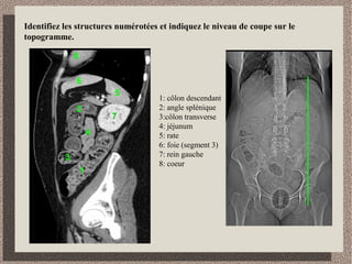 En vous référant au pancréas, identifiez la portion visible de l’estomac.
Visualisation de la queue du pancréas donc la portion
visible de l’estomac est la grosse tubérosité
pc
 