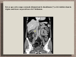 Est-ce que cette coupe coronale démontrant le duodénum (*) a été réalisée dans la
région antérieure ou postérieure de l’abdomen.
*
 