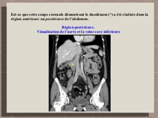 Est-ce que cette coupe coronale démontrant le duodénum (*) a été réalisée dans la
région antérieure ou postérieure de l’abdomen.
*
Région postérieure.
Visualisation de l’aorte et la veine cave inférieure
 