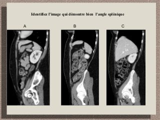Identifiez l’image qui démontre bien l’angle splénique
A B C
 