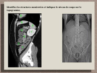 Identifiez les structures numérotées et indiquez le niveau de coupe sur le
topogramme.
1
2
3
4
5
6
7
8
 