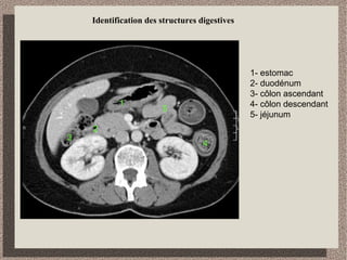 Identification des structures digestives
4
2
1
3
5
1- côlon descendant
2- côlon ascendant
3- grêle (iléon)
4- estomac
5- duodénum
 