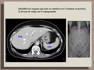 Identification des structures digestives
1
2
3
4
5
1- estomac
2- duodénum
3- côlon ascendant
4- côlon descendant
5- jéjunum
 