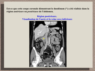 Identifiez la jonction gastro-oesophagienne.
Remarquez que
l’œsophage se
distingue
facilement de la
veine cave
inférieure par l’air
qu’il contient.
 