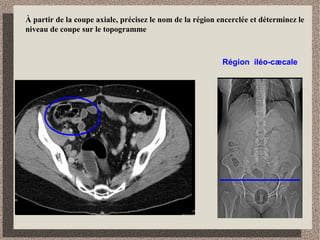 Identifiez les organes qui sont en relation avec l’estomac et précisez
le niveau de coupe sur le topogramme
estomac
 