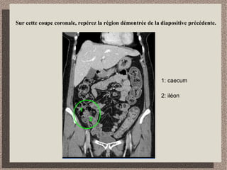 Identifiez les organes qui sont en relation avec l’estomac et précisez
le niveau de coupe sur le topogramme
foie
rate
estomac
 