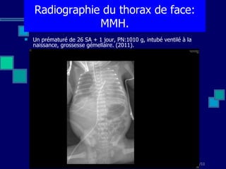 Un prématuré de 26 SA + 1 jour, PN:1010 g, intubé ventilé à la naissance, grossesse gémellaire. (2011). Radiographie du thorax de face: MMH. 