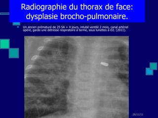 Un ancien prématuré de 25 SA + 4 jours, intubé ventilé 2 mois, canal artériel opéré, garde une détresse respiratoire à terme, sous lunettes à O2. (2011). Radiographie du thorax de face: dysplasie brocho-pulmonaire. 