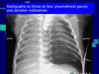 Radiographie du thorax de face: pneumothorax gauche avec déviation médiastinale. Pictures & Images                                                                                                                                                   Pneumothorax - Chest X-Ray gauche droite 