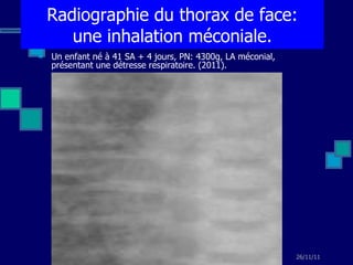 Un enfant né à 41 SA + 4 jours, PN: 4300g, LA méconial, présentant une détresse respiratoire. (2011). Radiographie du thorax de face: une inhalation méconiale. 