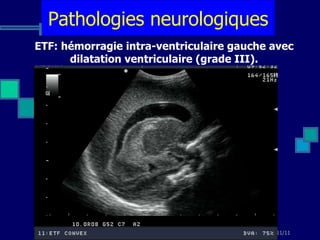 ETF: hémorragie intra-ventriculaire gauche avec dilatation ventriculaire (grade III). Pathologies neurologiques 