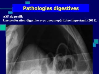 Pathologies digestives ASP de profil:   Une perforation digestive avec pneumopéritoine important. (2011). 
