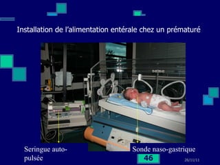 Installation de l’alimentation entérale chez un prématuré   Sonde naso-gastrique Seringue auto-pulsée 