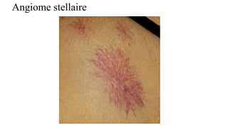 Angiome stellaire
 