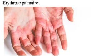Erythrose palmaire
 