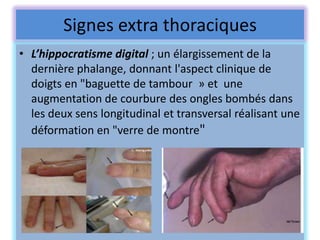 Signes extra thoraciques
• L’hippocratisme digital ; un élargissement de la
  dernière phalange, donnant l'aspect clinique de
  doigts en "baguette de tambour » et une
  augmentation de courbure des ongles bombés dans
  les deux sens longitudinal et transversal réalisant une
  déformation en "verre de montre"
 