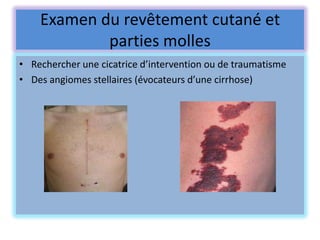 Examen du revêtement cutané et
            parties molles
• Rechercher une cicatrice d’intervention ou de traumatisme
• Des angiomes stellaires (évocateurs d’une cirrhose)
 