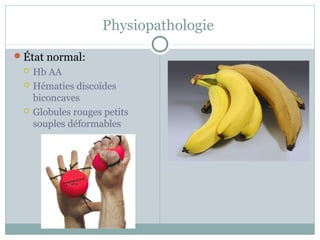 Physiopathologie 
État normal: 
 Hb AA 
 Hématies discoïdes 
biconcaves 
 Globules rouges petits 
souples déformables 
 