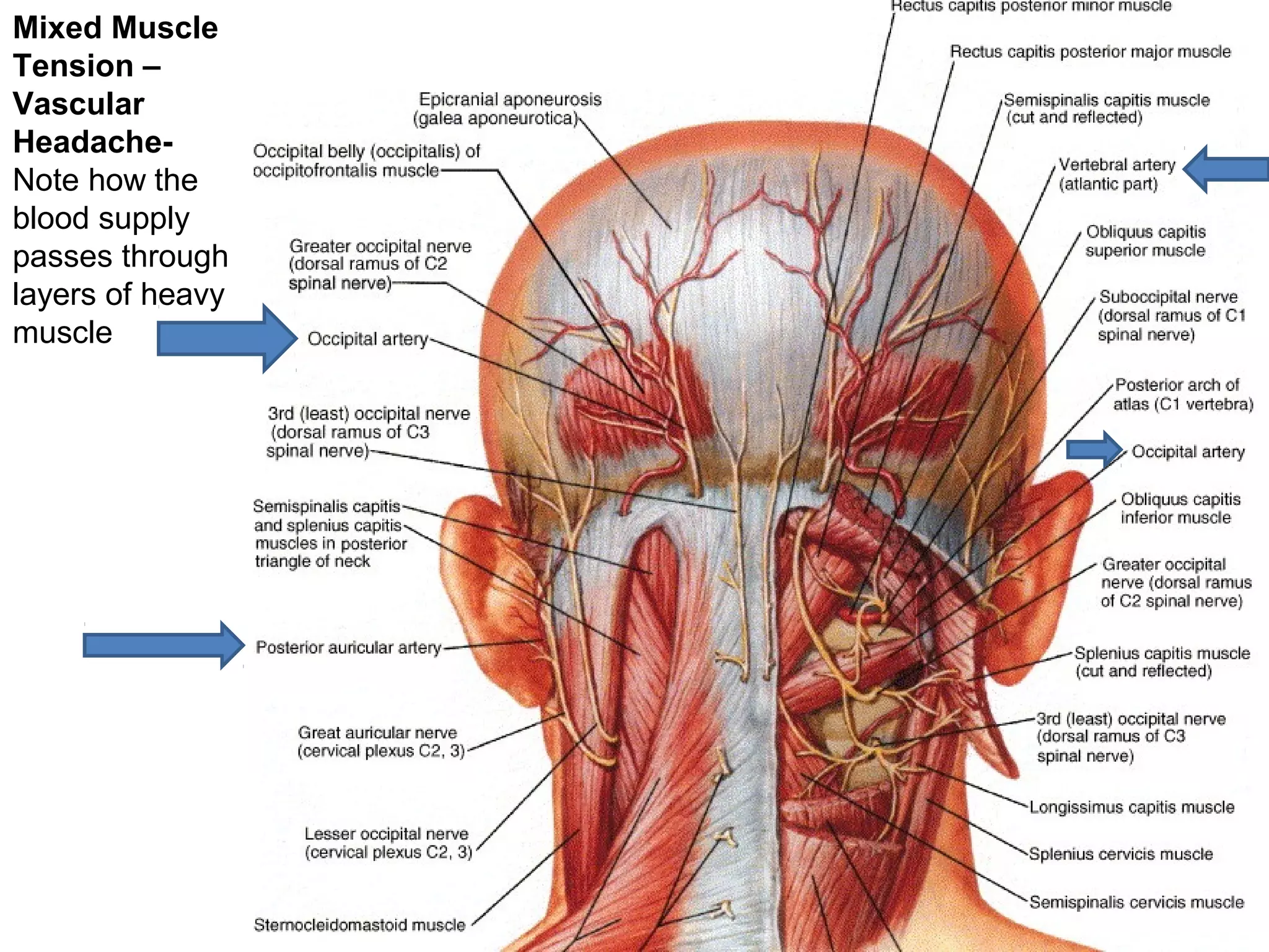 Mixed Muscle 
Tension – 
Vascular 
Headache- 
Note how the 
blood supply 
passes through 
layers of heavy 
muscle 
 