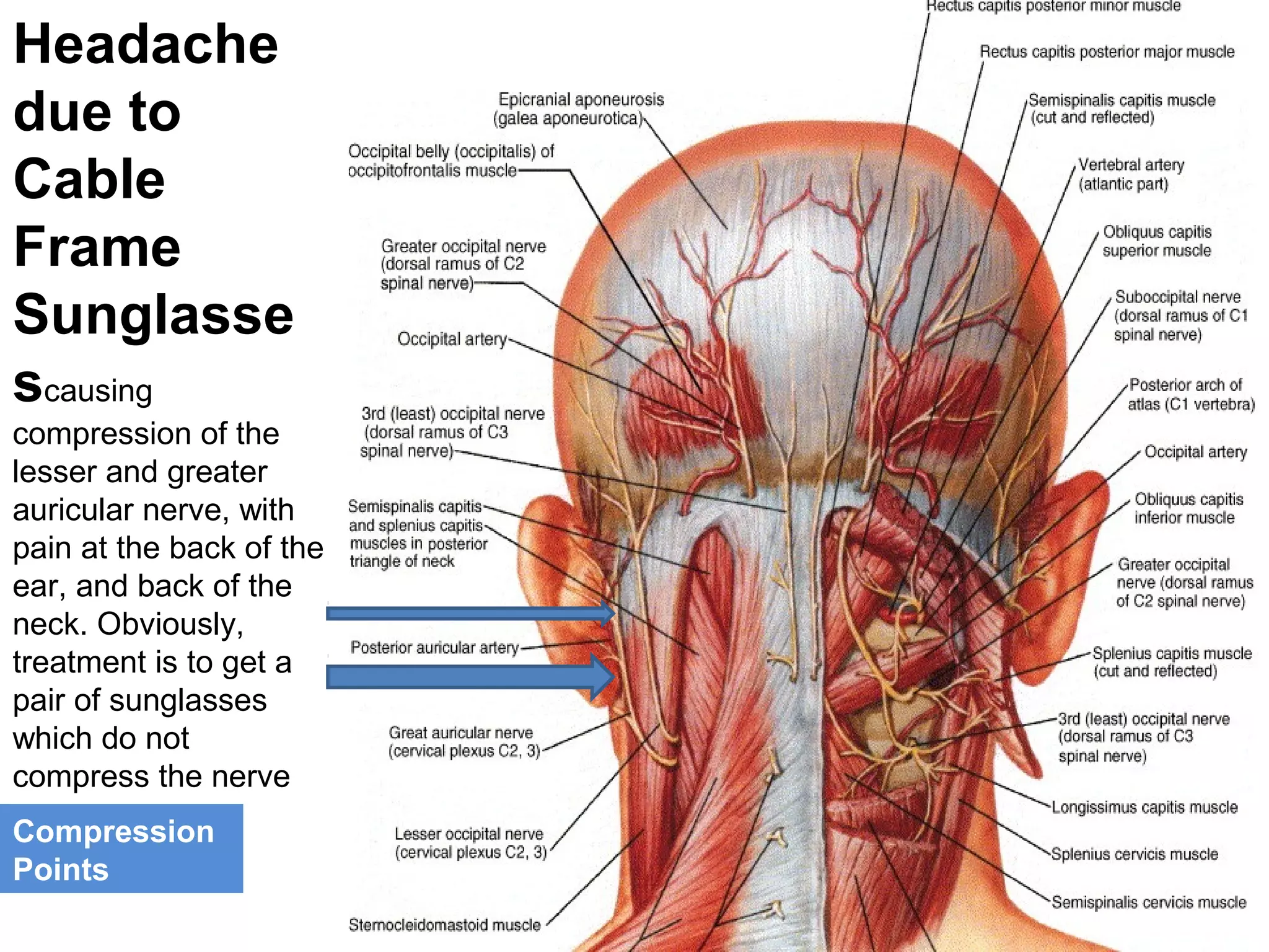 Headache 
due to 
Cable 
Frame 
Sunglasse 
scausing 
compression of the 
lesser and greater 
auricular nerve, with 
pain at the back of the 
ear, and back of the 
neck. Obviously, 
treatment is to get a 
pair of sunglasses 
which do not 
compress the nerve 
Compression 
Points 
 