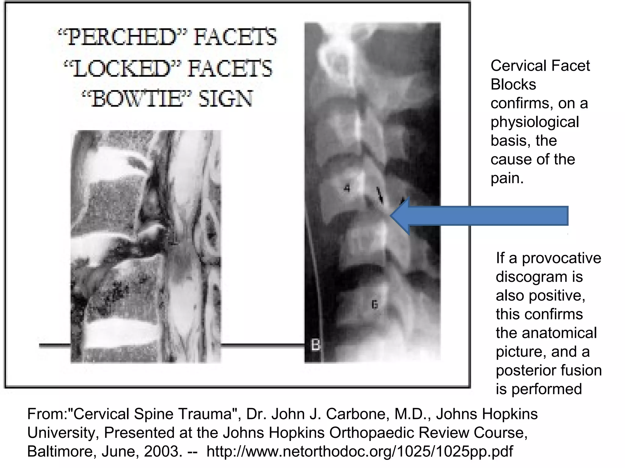 Cervical Facet 
Blocks 
confirms, on a 
physiological 
basis, the 
cause of the 
pain. 
If a provocative 
discogram is 
also positive, 
this confirms 
the anatomical 
picture, and a 
posterior fusion 
is performed 
From:"Cervical Spine Trauma", Dr. John J. Carbone, M.D., Johns Hopkins 
University, Presented at the Johns Hopkins Orthopaedic Review Course, 
Baltimore, June, 2003. -- http://www.netorthodoc.org/1025/1025pp.pdf 
 