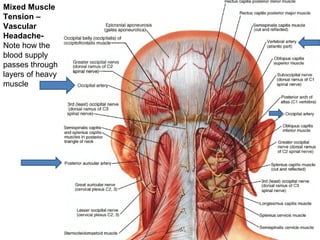 Mixed Muscle 
Tension – 
Vascular 
Headache- 
Note how the 
blood supply 
passes through 
layers of heavy 
muscle 
 