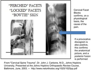 Cervical Facet 
Blocks 
confirms, on a 
physiological 
basis, the 
cause of the 
pain. 
If a provocative 
discogram is 
also positive, 
this confirms 
the anatomical 
picture, and a 
posterior fusion 
is performed 
From:"Cervical Spine Trauma", Dr. John J. Carbone, M.D., Johns Hopkins 
University, Presented at the Johns Hopkins Orthopaedic Review Course, 
Baltimore, June, 2003. -- http://www.netorthodoc.org/1025/1025pp.pdf 
 