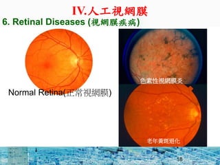 ? Wʧ߳^һAMD
? RP ПoЧί
C AMD: S(ҕWĤҕX^)
֢
C RP :ɫҕWĤ
18
Normal Retina(ҕWĤ)
ɫҕWĤ
S˻
6. Retinal Diseases (ҕWĤ)
IV.˹ҕWĤ
 