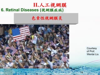 Retinitis Pigmentosa (RP)
19
Courtesy
of Prof.
Wentai Liu
6. Retinal Diseases (ҕWĤ)
ɫҕWĤ
II.˹ҕWĤ
 
