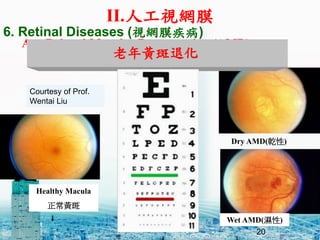 Age Related Macular Degeneration (AMD)
20
Healthy Macula
S
Dry AMD(Ǭ)
Wet AMD()
Courtesy of Prof.
Wentai Liu
6. Retinal Diseases (ҕWĤ)
S˻
II.˹ҕWĤ
 