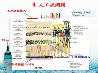 21
300 um
ҕWĤֲ
ҕWĤֲ
}jĤֲ(STS)
II. ˹ҕWĤ
Courtesy of Prof.
Wentai Liu
 