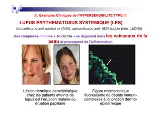 LUPUS ERYTHEMATOSUS SYSTEMIQUE (LES)
AutoanticorpsAutoanticorps antianti--nucléaires (nucléaires (ANAANA)),, autoanticorpsautoanticorps antianti-- ADNADN boublebouble brins (brins (dsDNAdsDNA))
Des complexes immuns « Ac-dsDNAdsDNA » se déposent dans les vaisseaux de la
peau et provoquent de l’inflammation
III. Exemples Cliniques de l’HYPERSENSIBILITE TYPE III
Lésion dermique caractéristique
chez les patients atteints de
lupus est l’éruption malaire ou
éruption papillaire
Figure microscopique
fluorescente de dépôts immun-
complexes à la jonction dermo-
épidermique
 