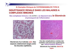 INSUFFISANCE RENALE DANS LES MALADIES A
COMPLEXES IMMUNES
Ceci e
de s
SLE.
dans
capilla
rose
sorte
capilla
voir
Des complexes immuns « Ac-dsDNAdsDNA » se déposent dans le Glomérule
et provoquent de l’inflammation
III. Exemples Cliniques de l’HYPERSENSIBILITE TYPE III
Glomérule d'un individu sain. Des
espaces relativement larges entre
les boucles capillaires.
Une des complications craintes des
maladies auto-immunes systémiques
est L'INSUFFISANCE RÉNALE.
Glomérule d'un individu atteint de
lupus
Ceci e
de s
SLE.
dans
capilla
rose
sorte
capilla
voir
 