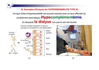 une taille
sur les
peuvent
manière
hiles et les
our, sont
rustrés».
ne se
ation des
bération
ui
n
e
ant les
s voies de
lement,
bi (caillots
usent une
e à une
Ce type d’état d’hypersensibilité est souvant associé avec un taux effondré du
complément plasmatique (Hypocomplémentémie)
Et nécessite la dialyse lors que le rein est touché
III. Exemples Cliniques de l’HYPERSENSIBILITE TYPE III
une taille
sur les
peuvent
manière
hiles et les
our, sont
rustrés».
ne se
ation des
bération
ui
n
e
ant les
s voies de
lement,
bi (caillots
usent une
e à une
 