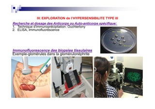 Immunofluorescence des biopsies tissulaires
Exemple-glomérules dans la glomérulonéphrite
IV. EXPLORATION de l’HYPERSENSIBILITE TYPE III
Recherche et dosage des Anticorps ou Auto-anticorps spécifique:
1. Technique d’immunoprécipitation: Ouchterlony
2. ELISA, Immunofluoréscence
Immunofluorescence des biopsies tissulaires
Exemple-glomérules dans la glomérulonéphrite
 