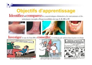 Objectifs d'apprentissage
Identifiezet comparezles caractéristiques distinctives, les mécanismes et les
principaux exemples d'hypersensibilités de type I, II, III et IV
Investigerle type de l’état HS et conseiller le médecin et le patient dans la prise en charge
 